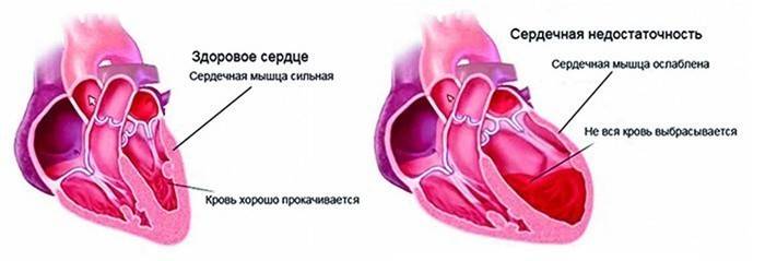 Insuficiență cardiacă