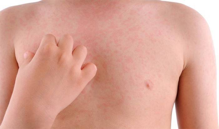 Eruzioni cutanee in un bambino