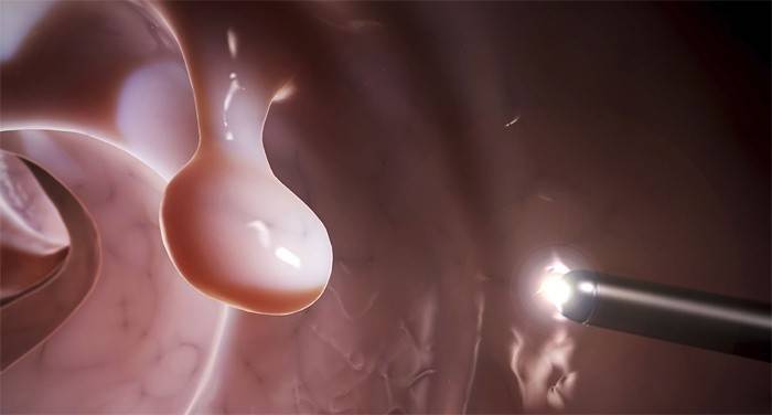 Polyp