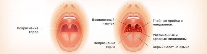 Катарални тонзилитис