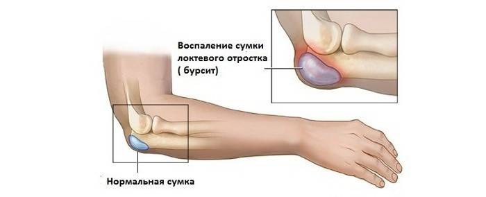Упала улнарног процеса