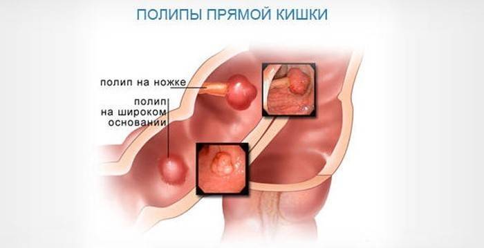 Polyoseis trông như thế nào?