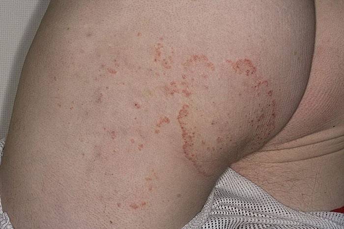 Miltä paavin ihottumat näyttävät?