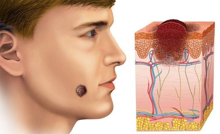Carcinoma a cellule basali