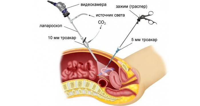Procedura di laparoscopia