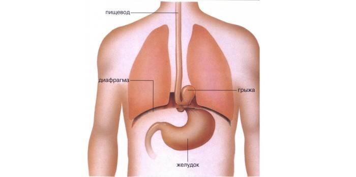 Sơ đồ biểu diễn vị trí thoát vị trong thực quản
