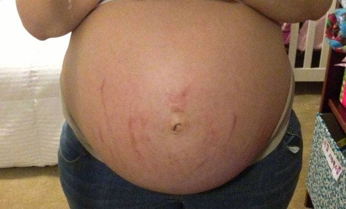 Raskaus Stretch Marks