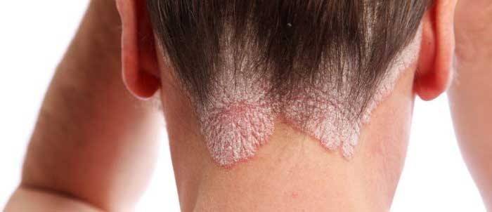 Psoriazė ant galvos ir veido