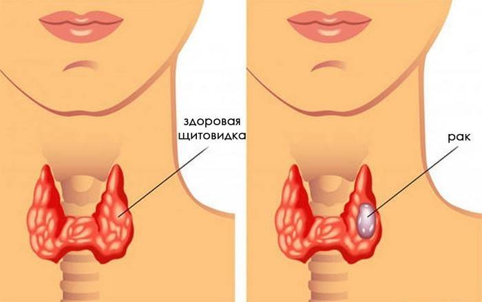 Ang tumor sa cancer