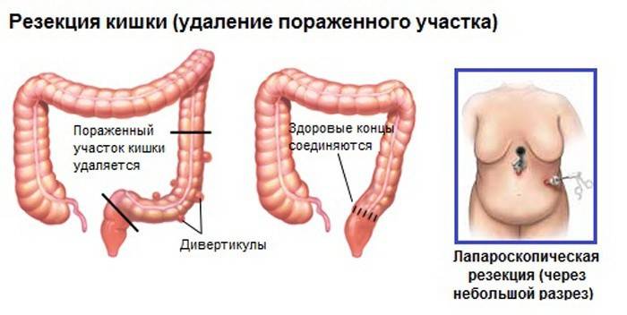 Cắt bỏ ruột