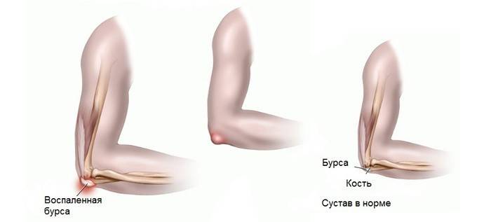 Поређење здравог и упаљеног лакта