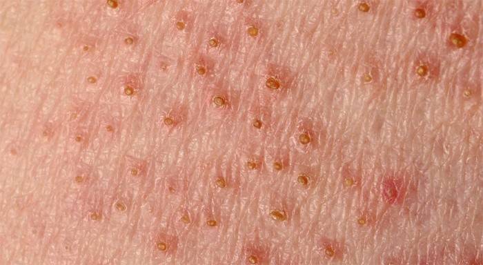 Pityriasis versicolor στο ανθρώπινο δέρμα