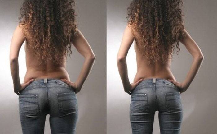 La ragazza ha perso peso con ozoterapia