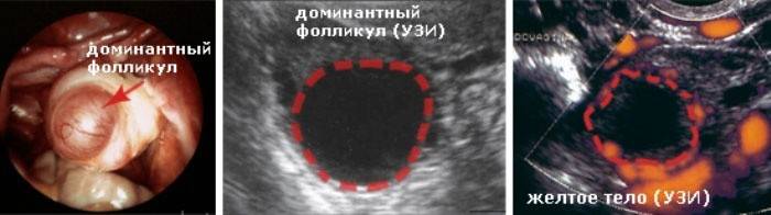 Ultraschallüberwachung des Follikelwachstums vor dem Eisprung