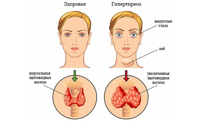 การเปรียบเทียบต่อมไทรอยด์ที่ดีต่อสุขภาพและ Hyperthyroidism