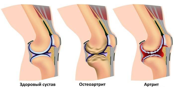 genou sain et après l'arthrite, l'arthrose