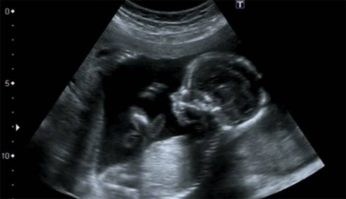 Ultrasonido a las 16 semanas de gestación