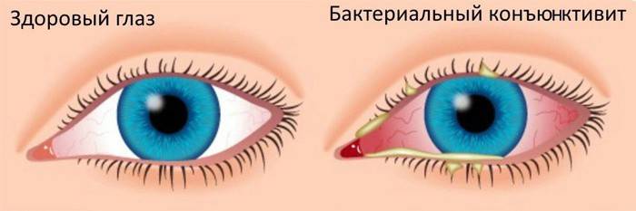 Здраво око и пацијент са бактеријским коњуктивитисом