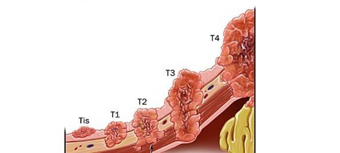 Etapele cancerului gastric