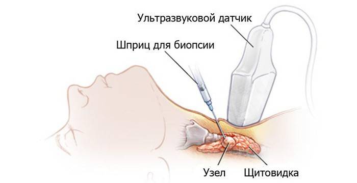 كيفية عمل ثقب الغدة الدرقية