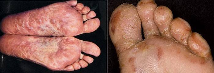 Eczema nos dedos dos pés