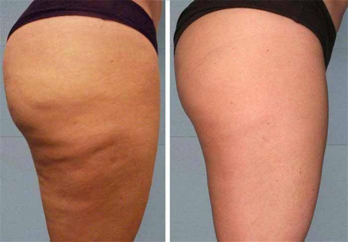 Le résultat de l'utilisation de miel de la cellulite
