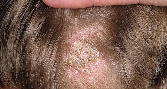 Ringworm στο τριχωτό της κεφαλής