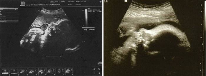 Ultrasuoni a 33 settimane di gestazione
