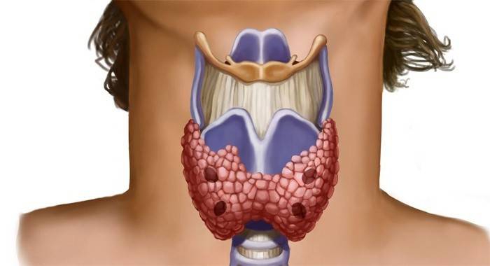 Ang hypothyroidism sa isang babae