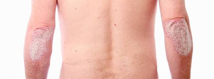 Ringworm στους ανθρώπους