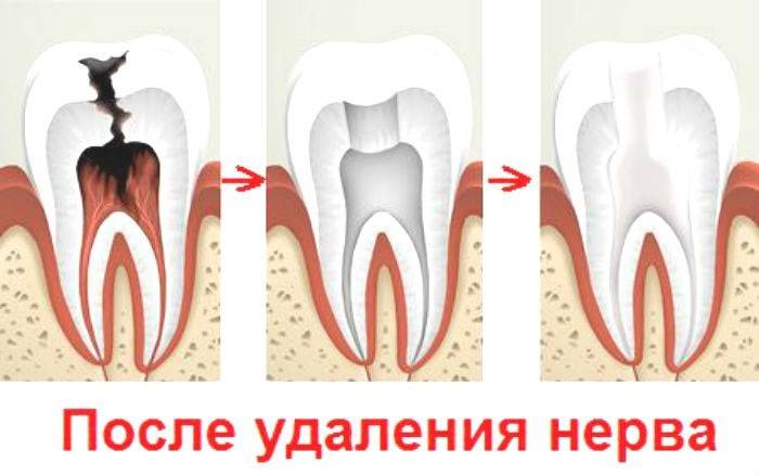 Răng sau khi cắt bỏ dây thần kinh
