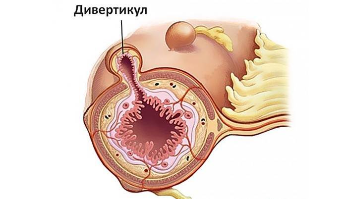 Các túi thừa trông như thế nào