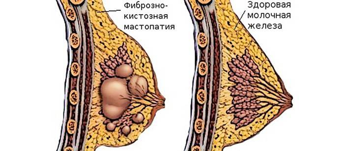 Comparaison d'un sein en bonne santé et d'une patiente souffrant de mastopathie