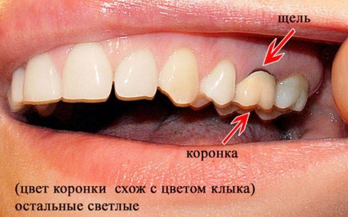 Vương miện cài đặt không chính xác