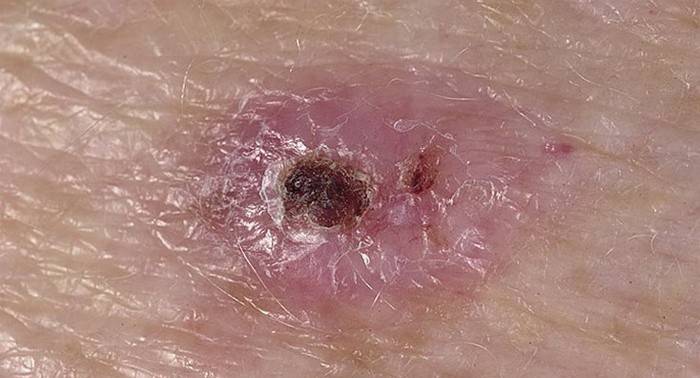 Carcinoma basocellulare della pelle del viso