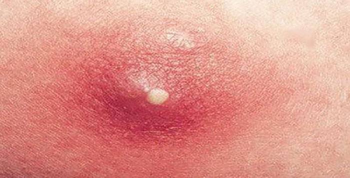 Pimple-valokuva