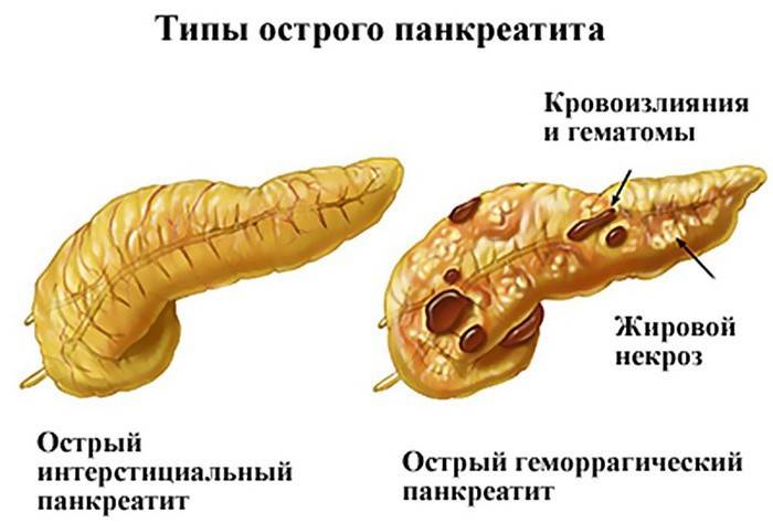 Видове остър панкреатит