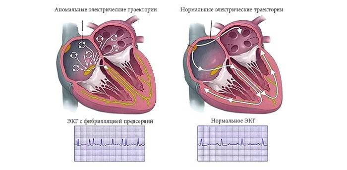 Az egészséges és beteg szív EKG-jének összehasonlítása