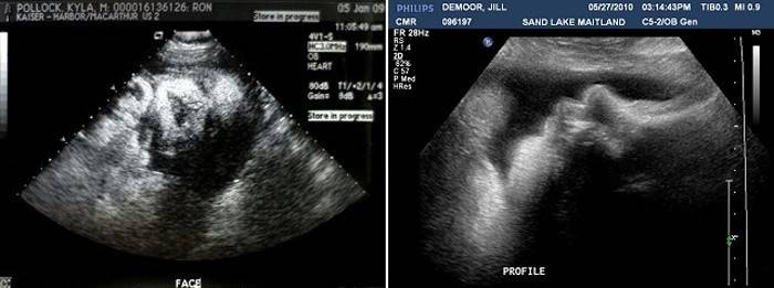 Ultrasuoni a 38 settimane di gestazione