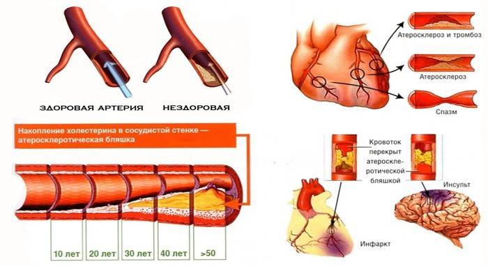 Натрупването на холестерол в съдовете