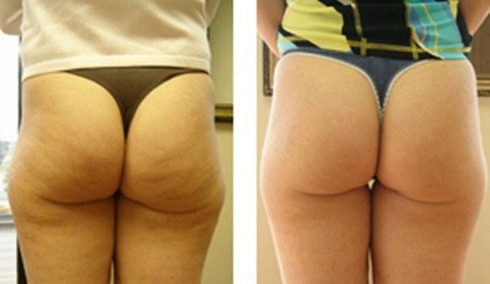Il risultato dopo il corso del farmaco