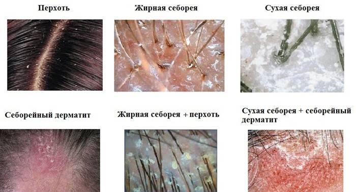 Các loại bã nhờn