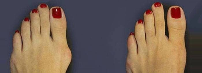 Phẫu thuật viêm burs: trước và sau