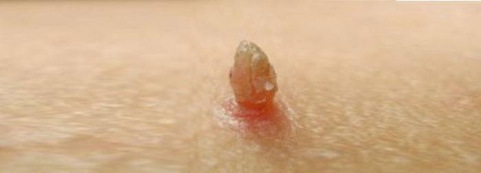candiloma มีลักษณะอย่างไร