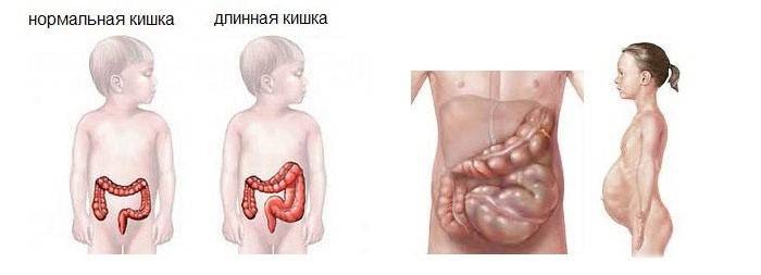 Foto della malattia di Hirschsprung