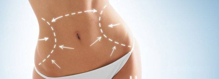 Abdominoplastika, siekiant pašalinti diastazę