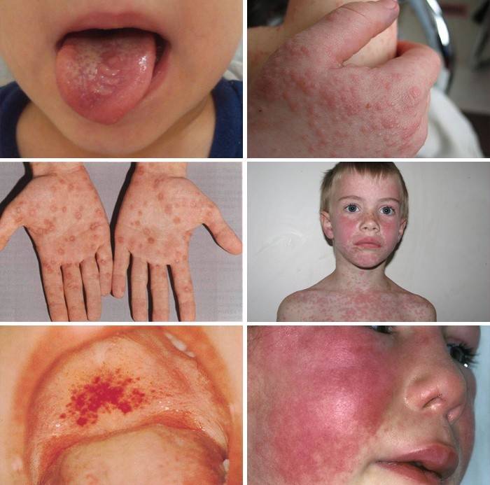 Eruzione cutanea da mononucleosi infettiva