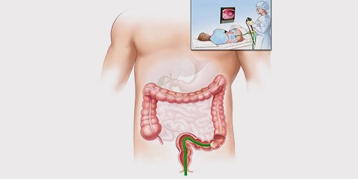 Fibrocolonoscopia a végbélbetegségek diagnosztizálására