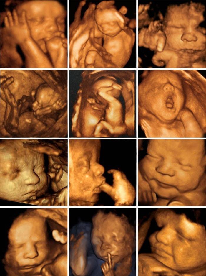 Üç boyutlu ultrason sonrası fetüsün fotoğrafı