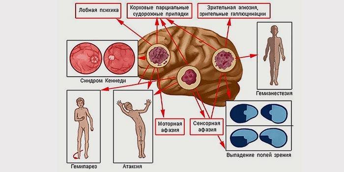 Segni di glioblastoma